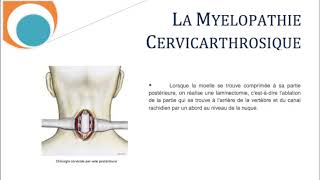 La Myélopathie Cervicathrosique Cervicarthrosis Myelopathy SFCR [upl. by Hurlee]