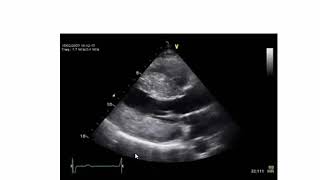 Tracing of Valvular Heart Disease Echo amp CMR Dr Youssef Amin [upl. by Egiarc26]