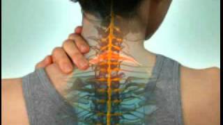 Cervical Radiculopathy  DePuy Videos [upl. by Cioban419]