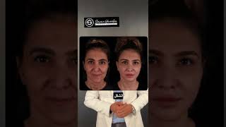 شد الشفايف العميق  Deep Plane Lip Lift ✨ drghoraba اكسبلور plasticsurgerydubai facelift [upl. by Botti]