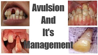 Avulsion  Avulsed tooth  Management  Treatment [upl. by Tara]