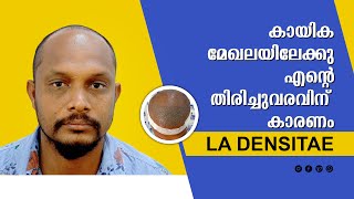 best hair transplant result malayalam  La densitae  Kochi  Trivandrum [upl. by Monie571]