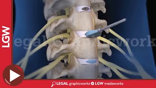 Cervical Discectomy amp Fusion Surgery 3D animation C3 C4 C5 C6 [upl. by Heyer449]