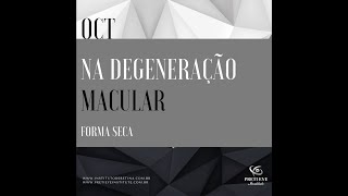 Degeneração macular seca com drusas [upl. by Barber]