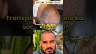 Hair Transplant Result 1 to 17 Days shortsfeed shortvideo hairtransplant myhairtransplant [upl. by Alinna]