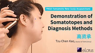 YNSA Yamamoto New Scalp Acupuncture Demonstration of Somatotopes and Diagnosis Methods [upl. by Ynaffit]