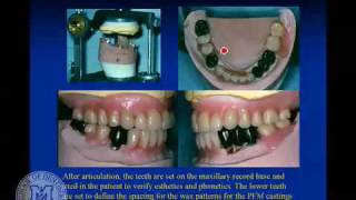 DENT 718 Partial denture attachments [upl. by Schaumberger]