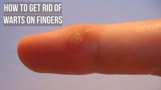 How to Get Rid of Warts on Fingers [upl. by Yadnus]