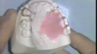 Orthodontic Acrylic Technique [upl. by Strephonn]