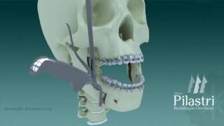 Cirurgia de Correção de Prognatismo [upl. by Alidia]