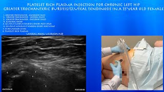 Ultrasound of Greater Trochanteric Bursitis Platelet Rich Plasma Injection in a 35 Year Old Female [upl. by Aveneg461]