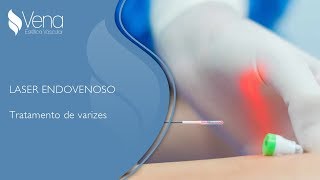 Tratamento de Varizes Laser Endovenoso  Vena Estética Vascular [upl. by Valeta]