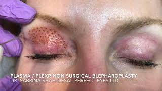 Nanoplasma or Plexr blepharoplasty [upl. by Syck756]