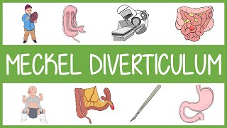 Meckels Diverticulum Mnemonic [upl. by Effy622]