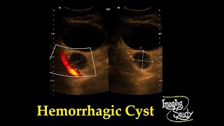 Adnexal Hemorrhagic Cyst  Ultrasound  Case 33 [upl. by Irpak272]