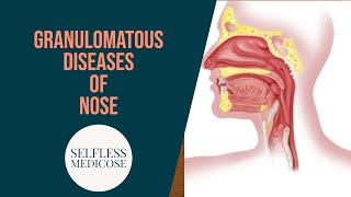 GRANULOMATOUS DISEASES OF NOSE part 3 mucormycosis wegeners granulomatosis in detail [upl. by Constance631]