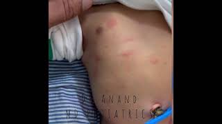 What is Erythema Toxicum  PediatricsByDrAnand [upl. by Esahc]