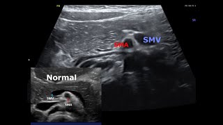 Midgut malrotation in Ultrasound  No volvulus [upl. by Sherar]