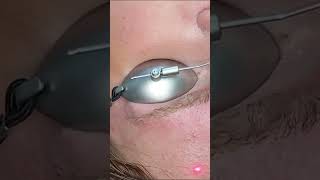 Pico Derma 4 laser tatoeage en permanente makeup verwijderen Noord Holland [upl. by Suivatna568]