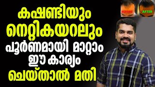 കഷണ്ടിയും നെറ്റികയറലും പൂർണ്ണമായി മാറ്റാം ഈ കാര്യം ചെയ്താൽ മതി bald malayalam [upl. by Minton]