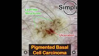 Pigmented Basal Cell Carcinoma Dermoscopy [upl. by Ahsain995]