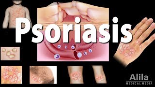 Psoriasis Types Symptoms Causes Pathology and Treatment Animation [upl. by Sherwynd]