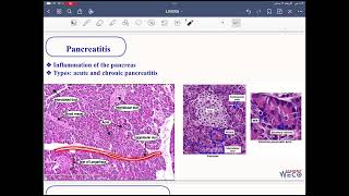 Pathology Hepatobiliary system 5 [upl. by Kuebbing602]