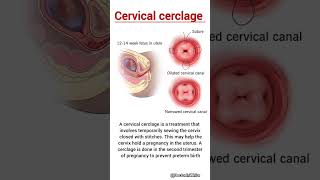 Cervical cerclage  viralvideo cervical cerclage obgy gynecology [upl. by Mirabelle]