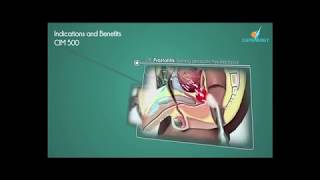 The new UroGynecology tecartherapy equipment of Capenergy C500 [upl. by Ettelorahc]