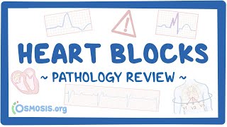 Heart blocks Pathology Review [upl. by Soulier]