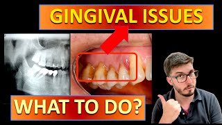 GINGIVITIS treatment vs PERIODONTITIS with TEETH STAINING gingivitis cleaning bleeding [upl. by Drahser545]