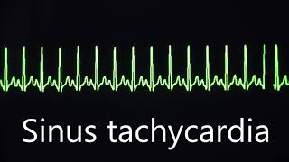 Sinus rhythm bradycardia and tachycardia [upl. by Esertap946]