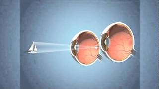 Monovision for Presbyopia [upl. by Delcine]