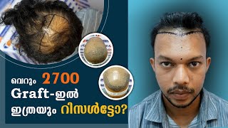 Hair transplant result Malayalam Best hair transplant clinic in kerala   La densitae Kochi [upl. by Nallak718]