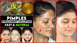 GET RID of PIMPLES NATURALLY  MY STORY  Remove PIMPLES In 21 DAYS  PIMPLE TREATMENT at HOME [upl. by Ynohtnanhoj214]