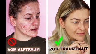 ❗️ In NUR 3 Monaten zur TRAUMHAUT  HEFTIGES Ergebnis ❗️ Microneedling Vorher Nachher Diana Delo [upl. by Severen499]