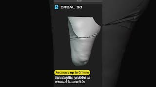 iReal 3D Scanning Helps Prosthetic Socket Customization 3dscanning healthcare medical [upl. by Kcirdla]