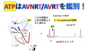 心電図：暗記からの卒業 132話 ATPによる上室性頻拍の鑑別２ [upl. by Benn]