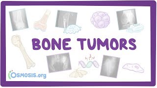 Bone tumors  causes symptoms diagnosis treatment pathology [upl. by Ordisy]