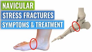 Navicular Stress Fracture Symptoms amp Treatment [upl. by Eimareg]