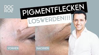 Cryopen entfernt Pigmentflecken sicher amp schnell [upl. by Aihsilef]