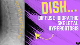 DISH Diffuse Idiopathic Skeletal Hyperostosis [upl. by Siduhey]