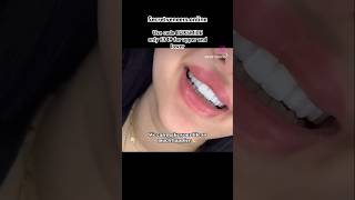 The best clip on veneers on the market [upl. by Norreg]