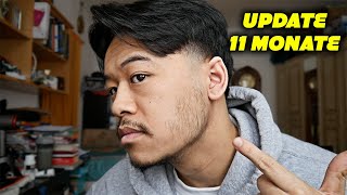 MEIN MINOXIDIL BART EXPERIMENT UPDATE 11 MONATE NEWS [upl. by Bayless]