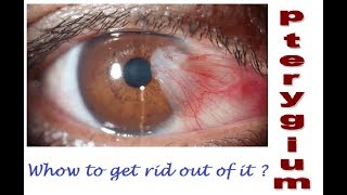 what is pterygium How to get rid out of it Hindi [upl. by Ajet]