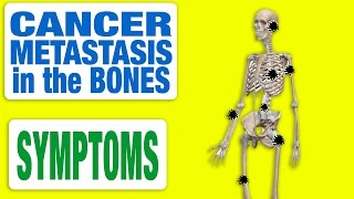 Cancer Metastasis in the Bones  All Symptoms [upl. by Lorraine]