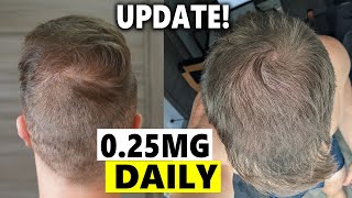 Finasteride Microdosing Update 2022 [upl. by Fair]