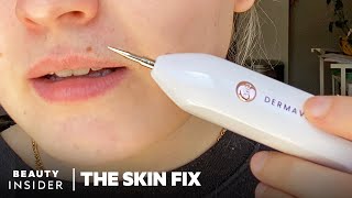 Heated Needle Tool Claims To Remove Skin Tags And Moles At Home  The Skin Fix  Beauty Insider [upl. by Fabrianne]