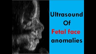 Ultrasound of fetal face anomalies [upl. by Adamsen]