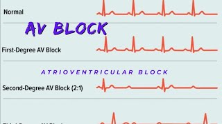 Atrioventricular Block  AV block Causes and Types [upl. by Annwahs]